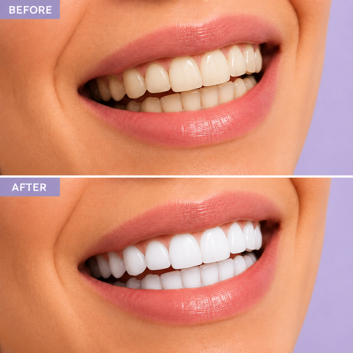 Smole Teeth Whitening