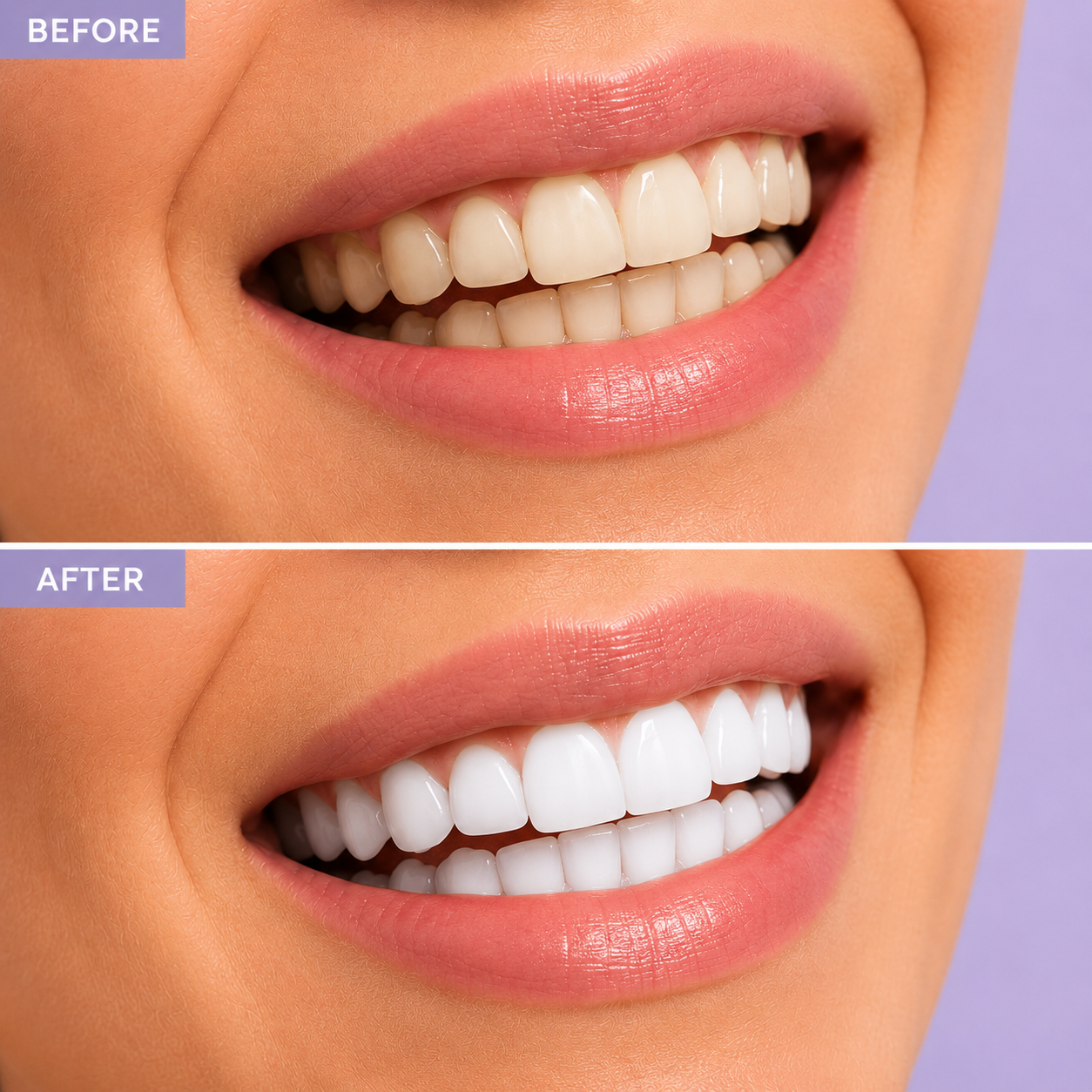 Smole Teeth Whitening